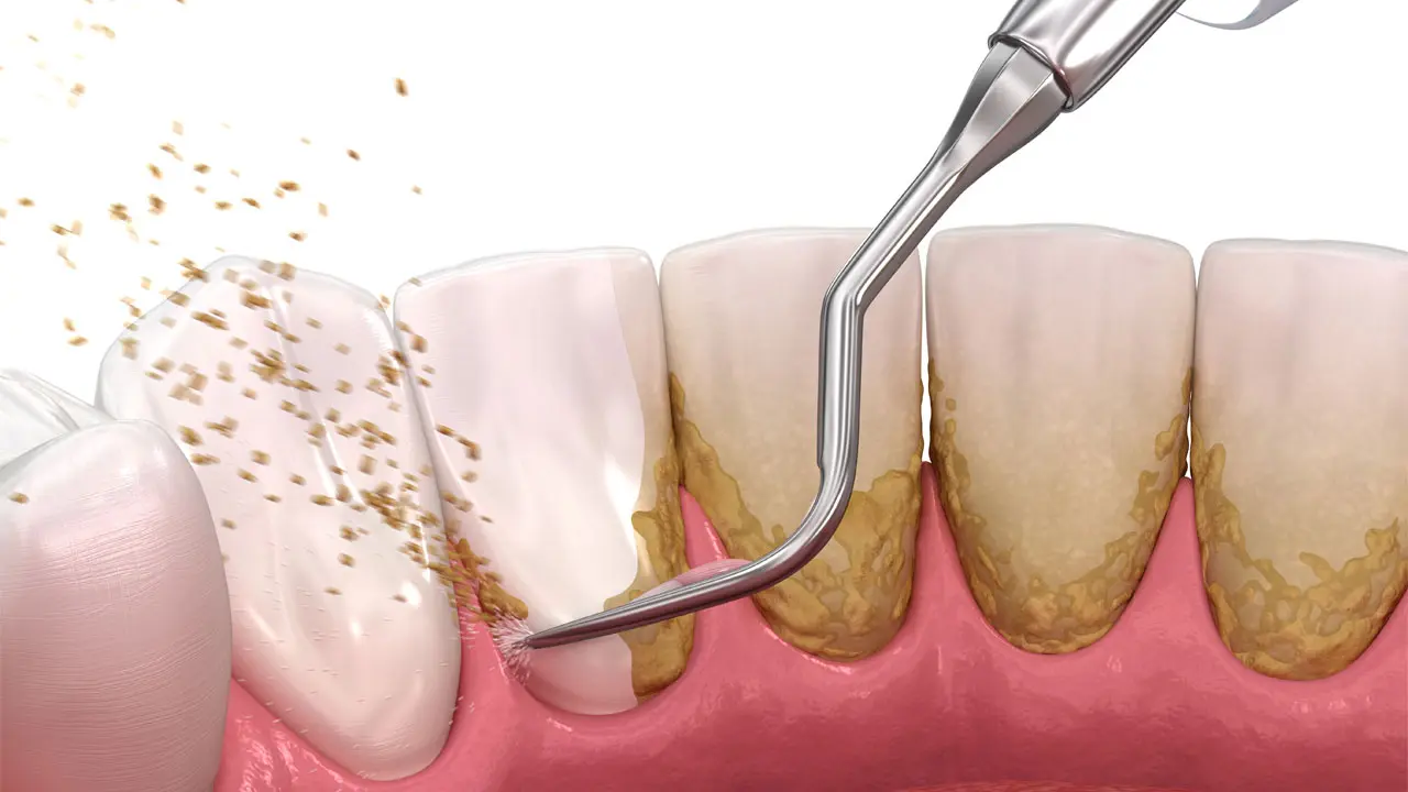 Treating Periodontal Disease - Valley Dental Care of Plainfield
